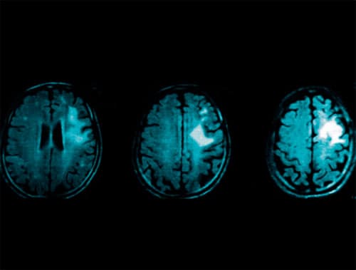 RNM de cráneo con gadolineo que evidencia lesión frontal cortico
subcortical derecha hiperintensa en TW1, con leve efecto de masa. 