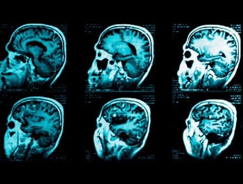 RNM sagital TW1 con contraste que evidencia lesiones hiperintensas frontales y temporales derechas con leve efecto de masa